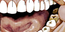 FOB seleciona pessoas sem dentes pr-molares